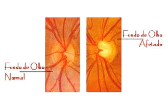 Aspecto do Nervo Óptico com Glaucoma